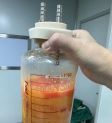唐山水动力吸脂手术要做多久？
